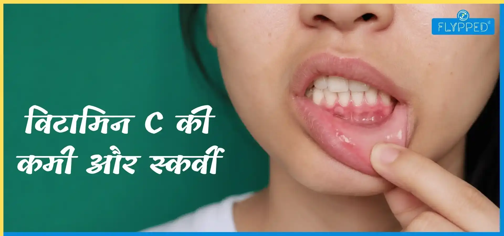  Scurvy Meaning in Hindi: विटामिन C की कमी और स्कर्वी