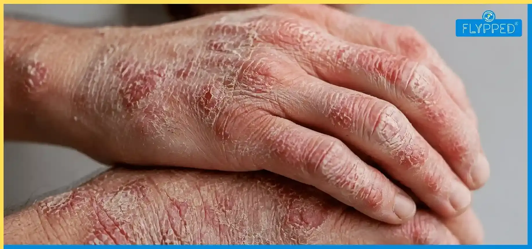 Leprosy Meaning In Hindi: क्या कुष्ठ रोग पूरी तरह ठीक हो सकता है? जानिए सच्चाई
