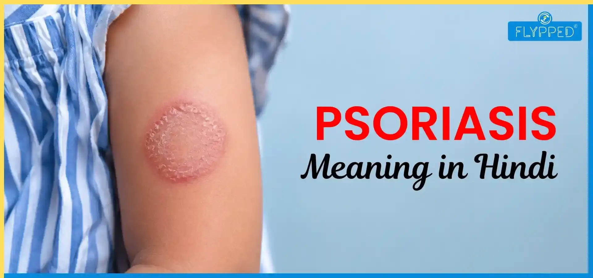 Psoriasis Meaning in Hindi: सोरायसिस क्यों होता है? जानिए लक्षण और उपाय